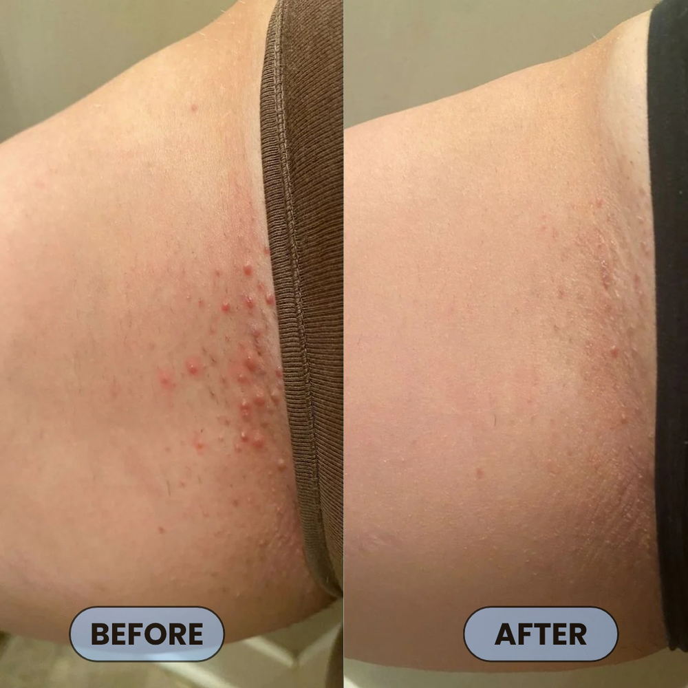 <p>Users Share How #1 Bump Free Solution™ Changed Their Skin</p>