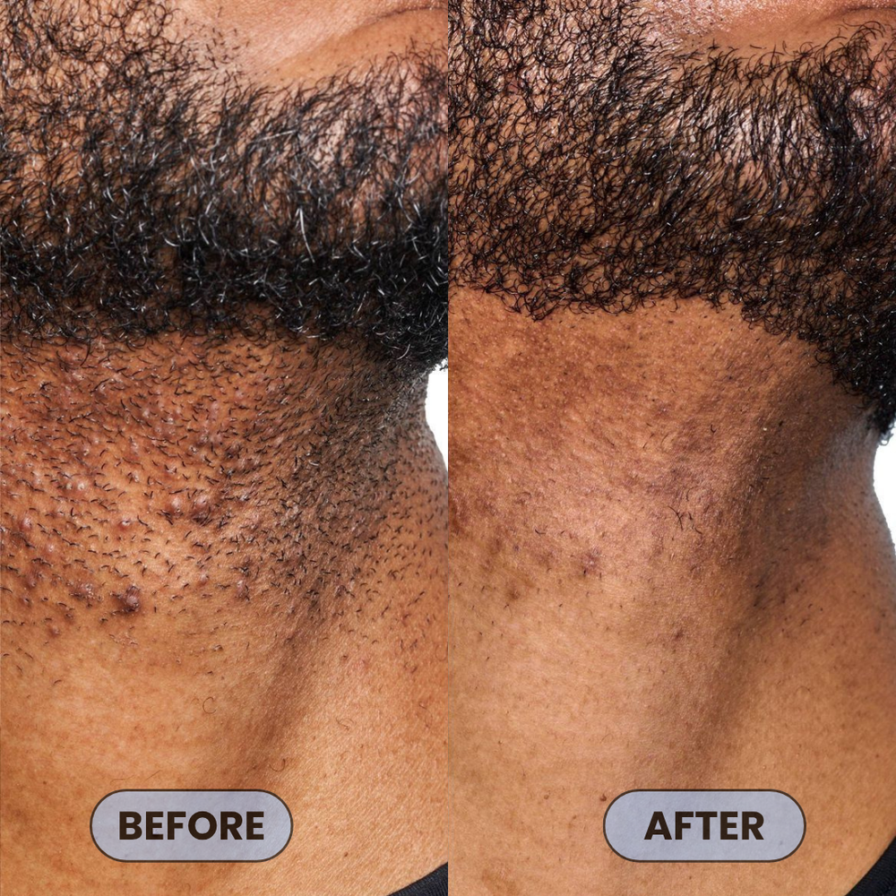 <p>Users Share How #1 Bump Free Solution™ Changed Their Skin</p>